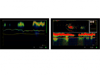 TrawlSonar_TS-360_dual screenfFuruno Norge